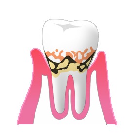 軽度歯周病の場合