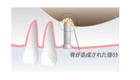 ソケットリフト
